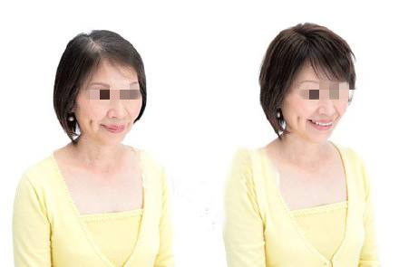 天津美丝特科技增发中心韩医生给您介绍关于织发补发的事情