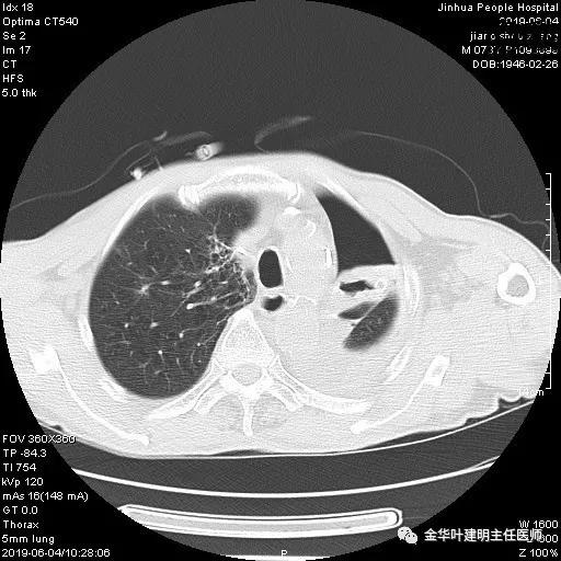 手术引起乳糜胸,有没有做了肺结节手术后是误诊的