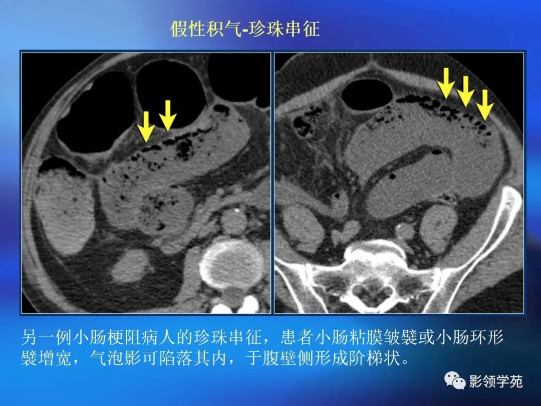 肠道内壁增厚,肠道扩张ct表现