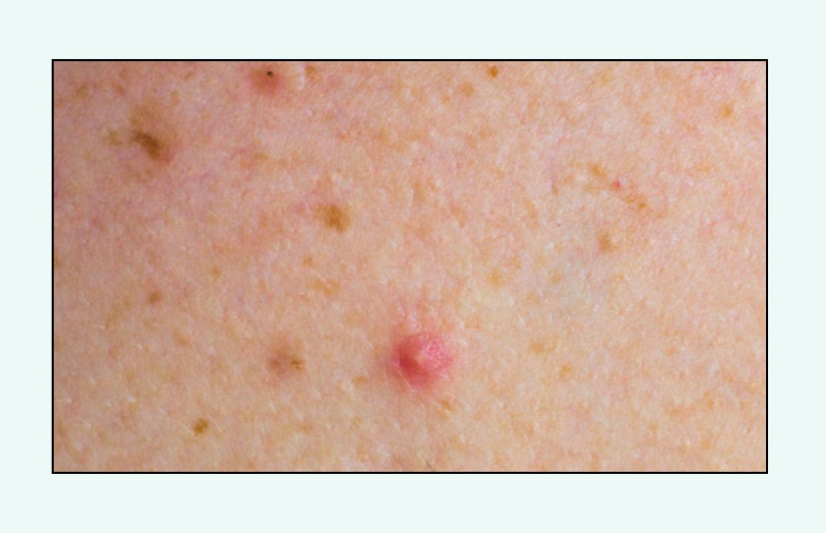 脸上的红疙瘩疼是什么原因,脸上的各种疙瘩