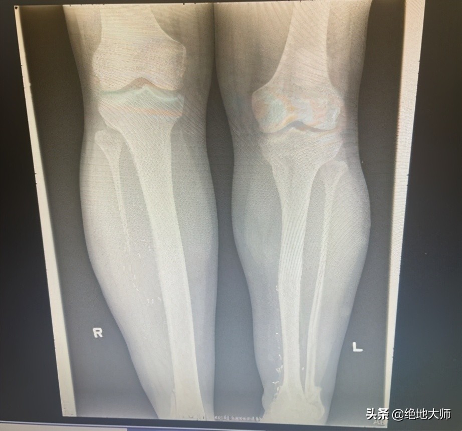 腿长短不一样怎么诊断,腿长短不一怎么调理