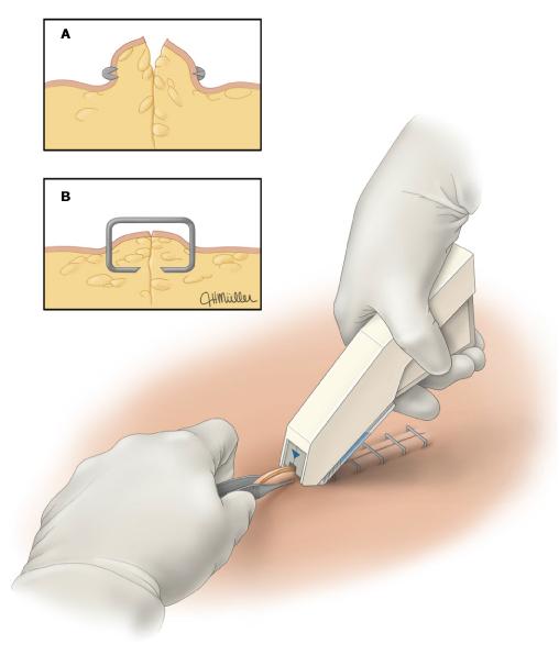 外伤缝合人工好还是订书机缝合好,骨科手术为什么用缝合钉