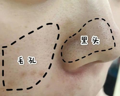黑头到底怎么彻底除去,黑头要怎么彻底清除