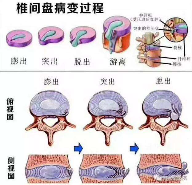 腰椎间盘突出怎么办,腰椎间盘突出屁股疼
