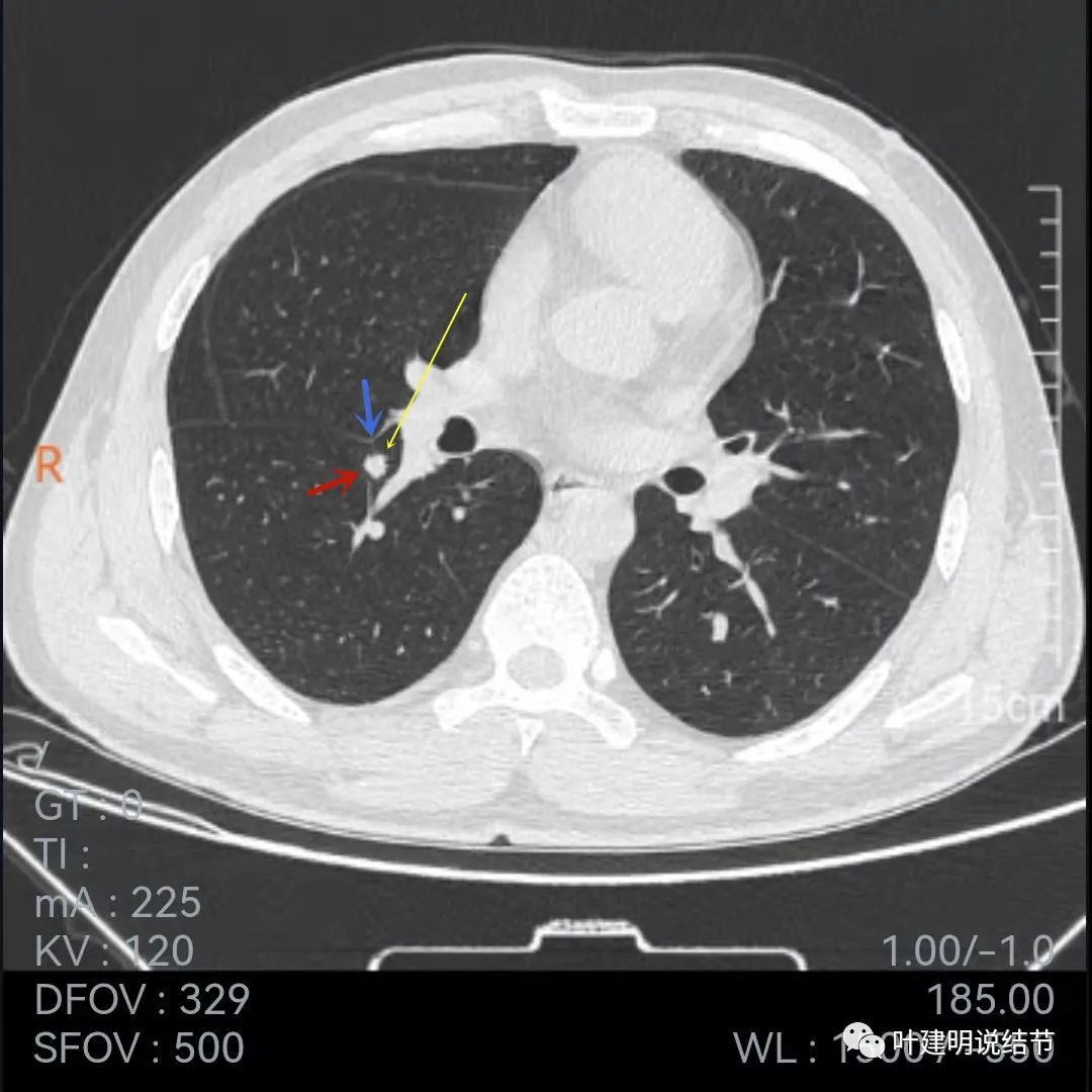 问诊分析：存在了4年的实性结节会不会是肺癌？