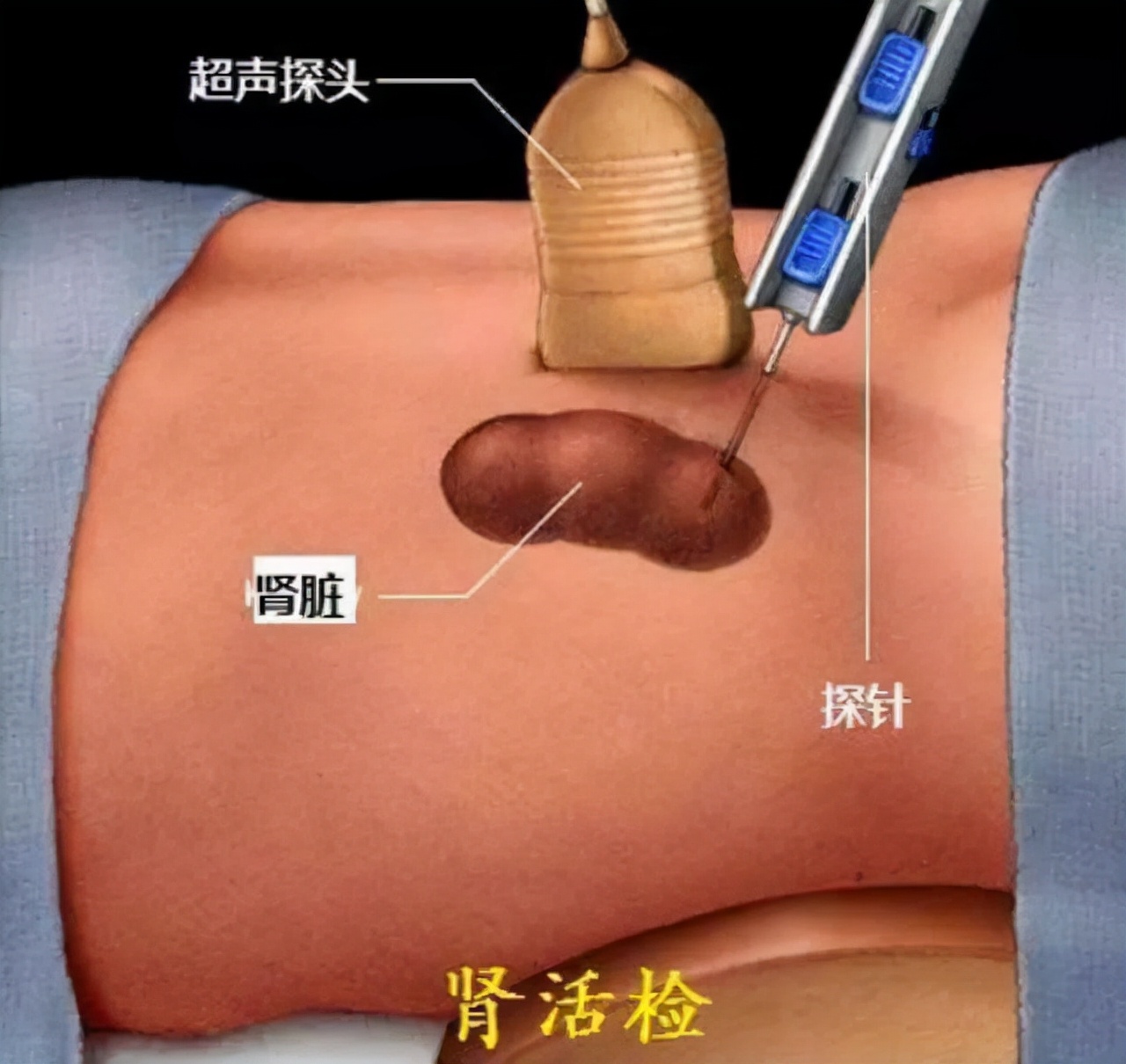 什么是肾穿刺,什么是肾穿刺检查