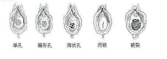 有过夫妻生活,那层膜就一定会破吗?