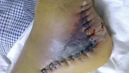 左股骨粗隆间粉碎性骨折微创手术,跟骨粉碎性骨折微创手术最快多久