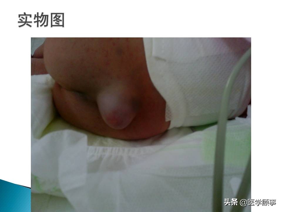 先天性脊柱裂是怎么来的,先天性脊柱裂的孕妇