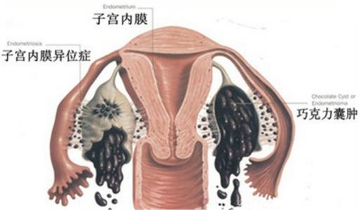 腺肌症+巧囊，这一路实在太难，后来才知道这俩可以一起解决