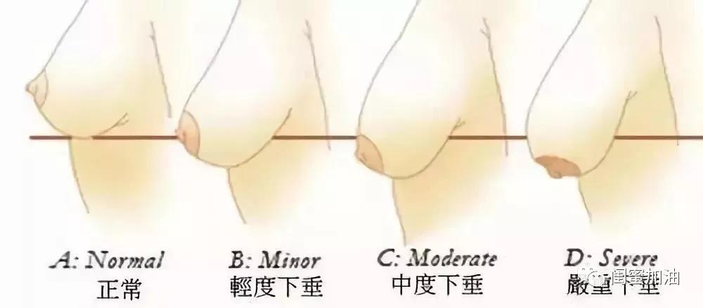 产后胸部干瘪下垂怎么恢复挺拔,恢复产后胸下垂动作