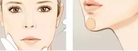 隆下巴后,整张脸都会变美了