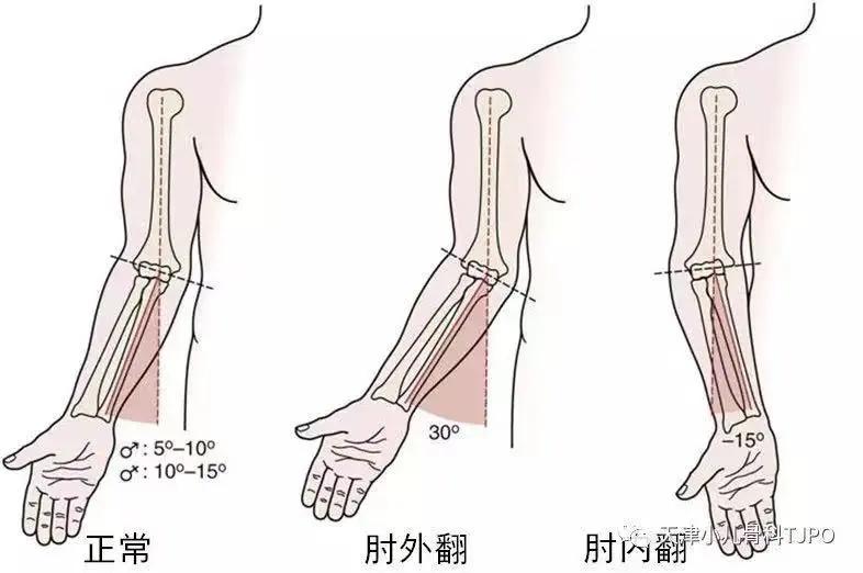 儿童胳膊肘朝外拐怎么办,小孩胳膊肘往外拐为什么会黑