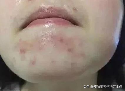 吃火锅长痘,怎么吃火锅才能同时拥有快乐和好皮肤?