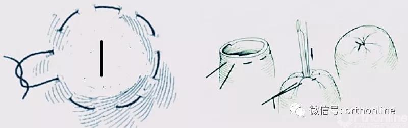 十种外科基本缝合方式详解,手术切口缝合有哪几种