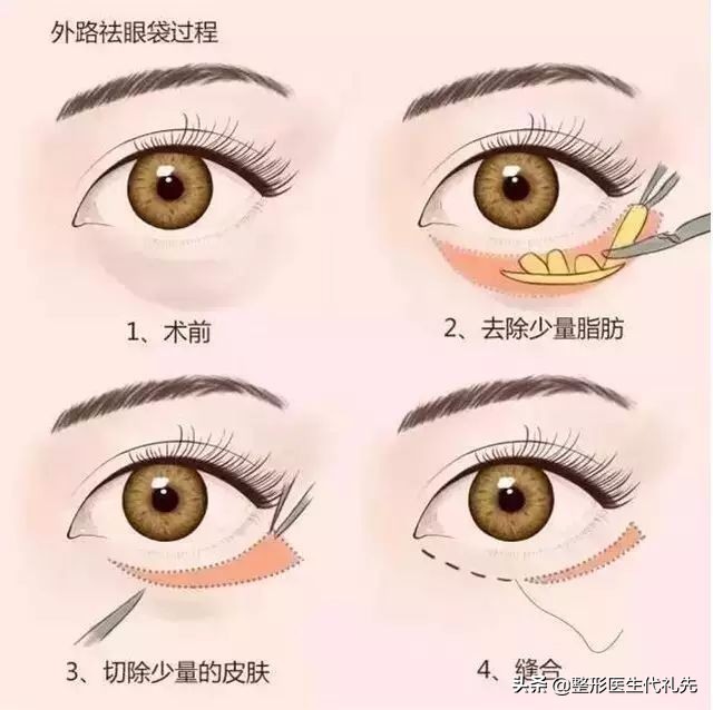 祛眼袋眼睑轻度外翻悬吊多久能好,外切口去眼袋面部提升能维持多久