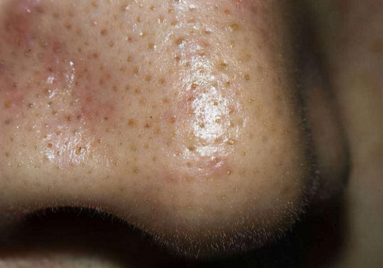 青春期男孩子如何正确去黑头,男孩子怎么祛黑头