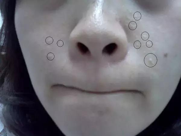 脸上有螨虫的10个征兆,脸上有螨虫的人要注意了