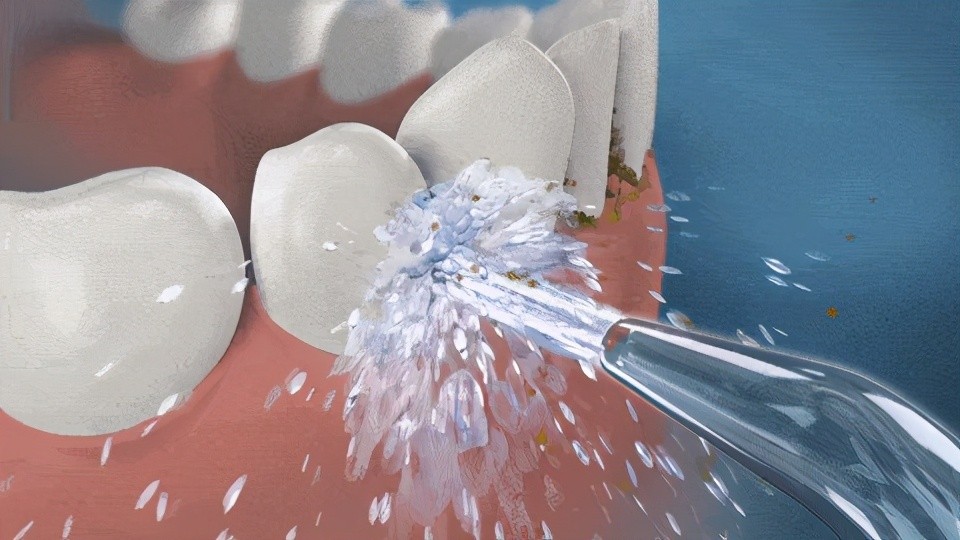 一般看个牙痛多少钱,看个牙包要多少钱