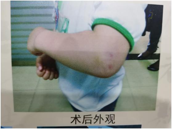 骨折一定要打石膏吗,骨折非要打钢钉吗