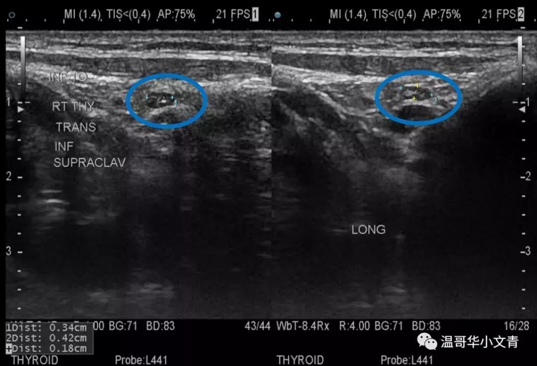 甲状腺癌治疗最好的医院排名,中药治疗甲状腺癌的有效方法