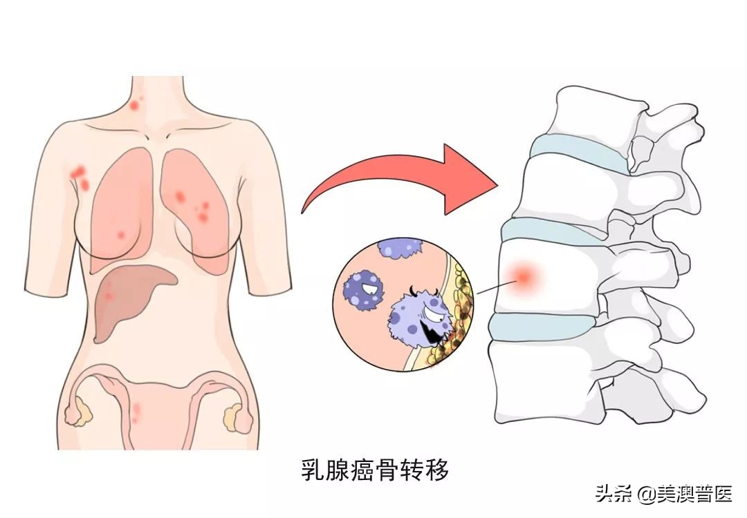 肺癌晚期骨转移有必要化疗吗,肺癌晚期出现骨转移该怎么办