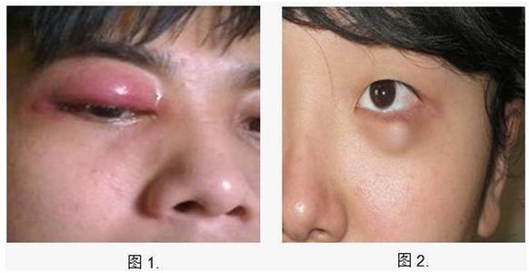 下眼睑黑眼圈特别严重是怎么回事,黑眼圈严重眼袋浮肿是什么原因