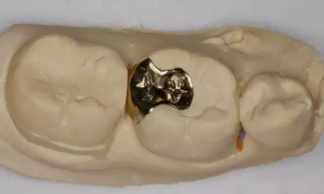 为什么补牙的材料会容易脱落,补牙后材料脱落可以补上吗