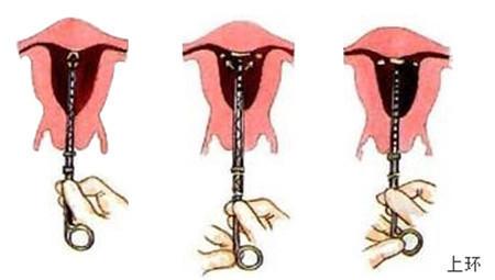 生娃以后，上环还是结扎？哪种避孕方式对女人更好？