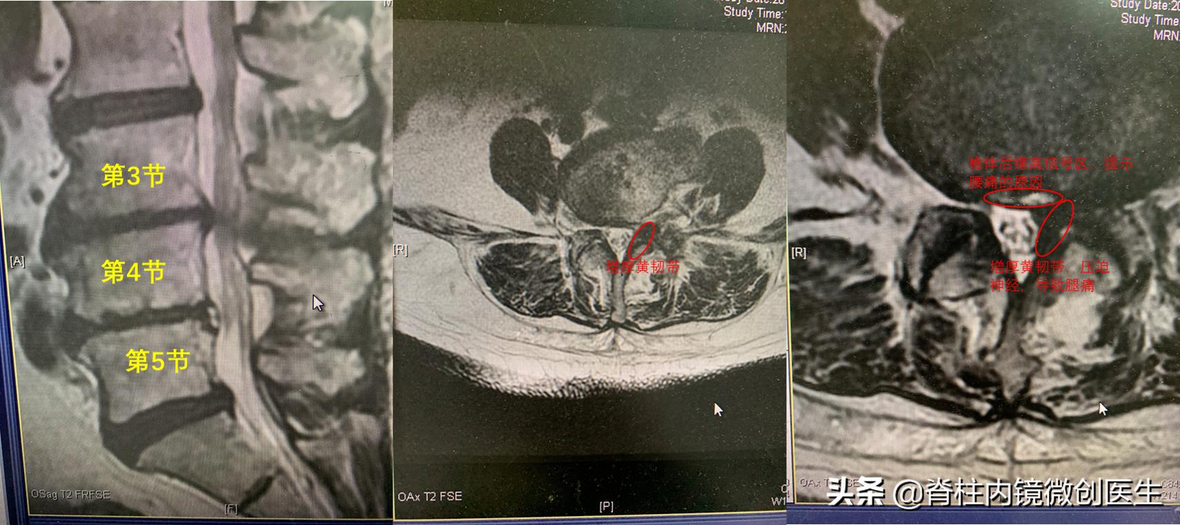 老年腰椎管狭窄的手术治疗,微创手术治疗腰椎管狭窄的技术