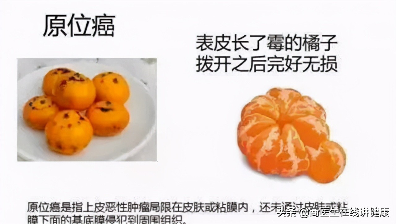 几个月内形成的浸润癌易复发么,浸润癌恶性