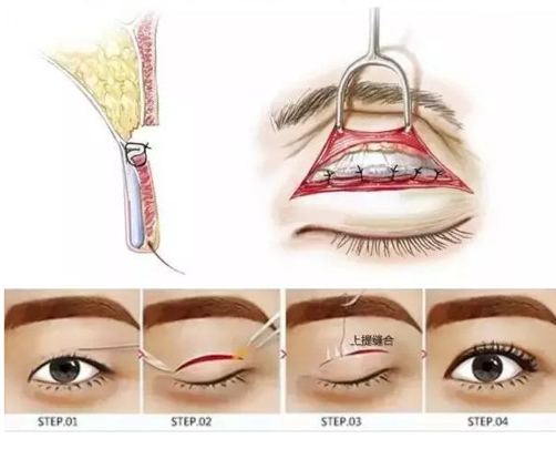 切眼袋会加速衰老的案例,割双眼皮衰老更快