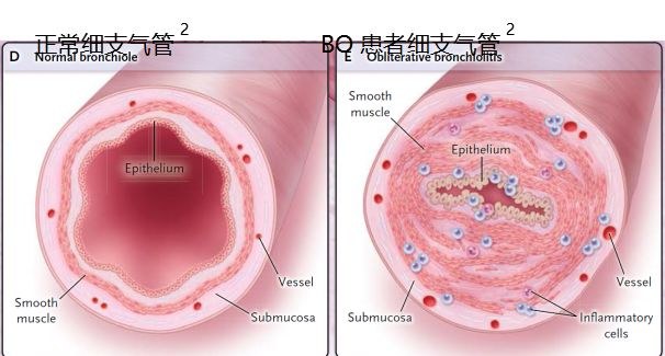 儿童流感病毒引发的肺炎,儿童肺感染病毒