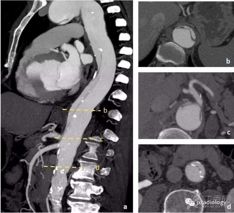 急性主动脉综合征报道,急性主动脉综合征症状
