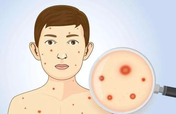 水痘一般在冬春季节更容易感染么,水痘每年春天和秋天都复发怎么办