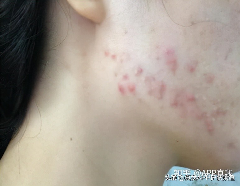 去闭口应该刷酸还是用药,闭口粉刺用果酸还是水杨酸比较好