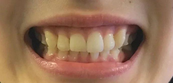 牙齿很整齐拔牙正畸前后效果,虎牙齿矫正的前几天有什么反应