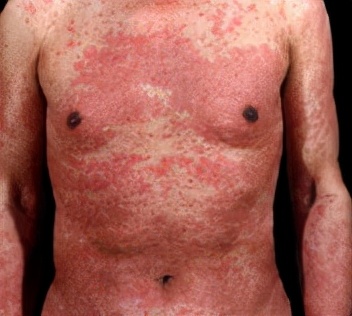 接触性皮炎怎么治疗才能彻底除根,接触性皮炎会疼吗