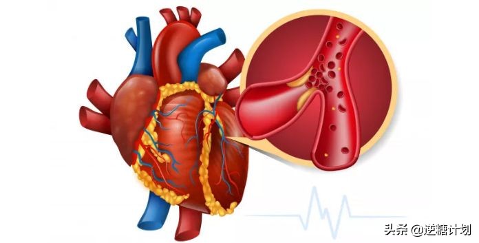 糖类和血脂的区别,糖类吃多了会引起血脂粘稠吗
