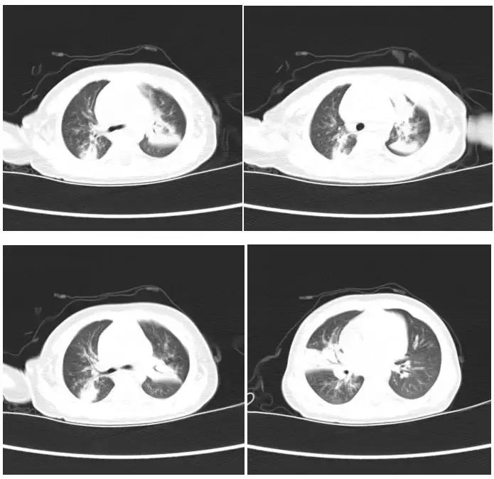 宝宝得了肺炎、流感？纤维支气管肺泡灌洗术了解一下