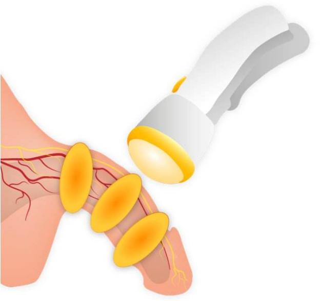 「勃起功能障碍」可以做这种康复治疗,再不了解就晚了