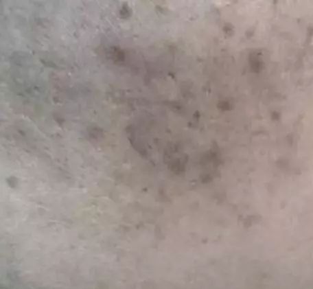 痘痘不可怕泛红才可怕,痘痘不是非常严重要不要管