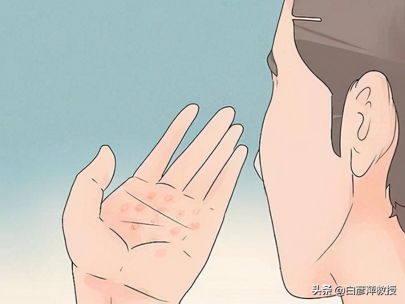 湿疹是什么原因造成的湿疹怎么治,肛周湿疹其他部位也有湿疹怎么办