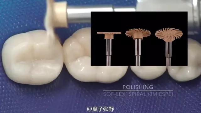 补牙疼吗补牙过程图,补牙全部过程是什么样子的