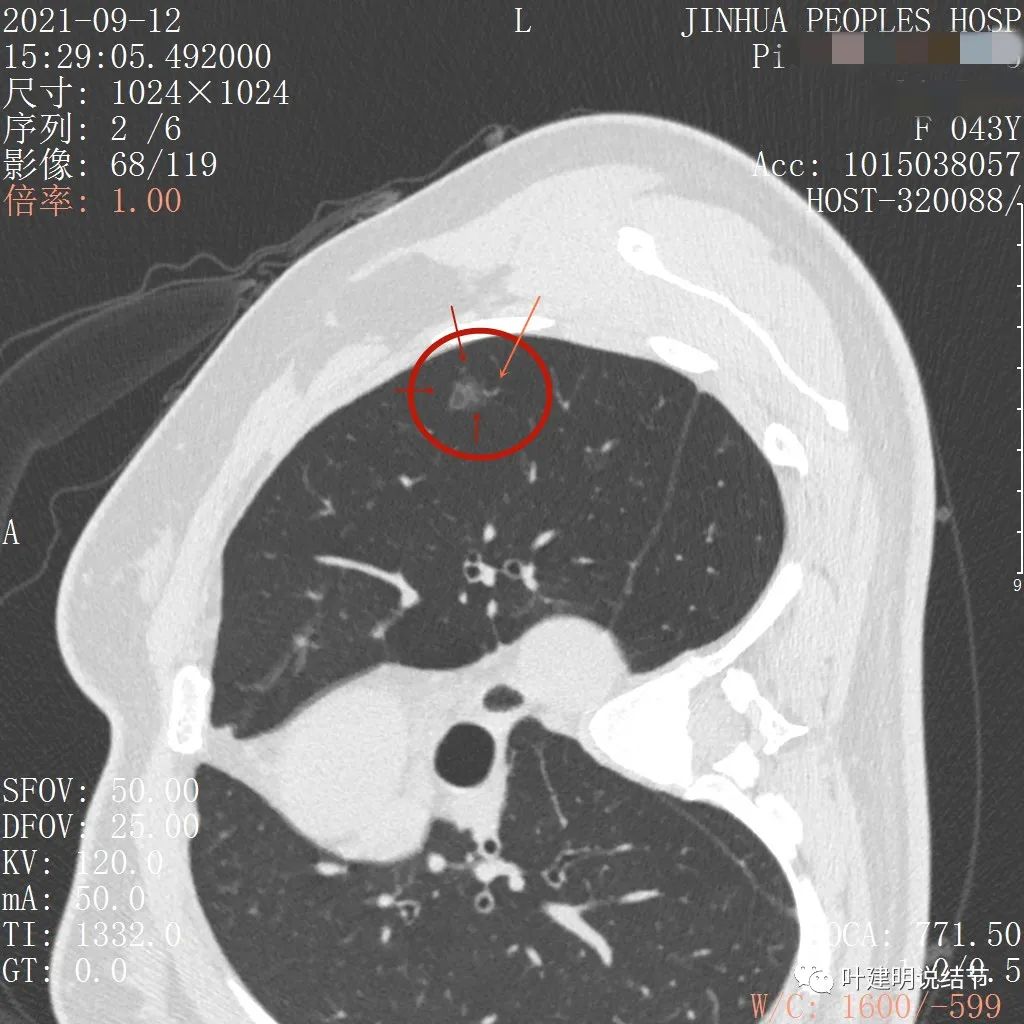 怎样从病理报告看是不是原位癌,原位腺癌切除子宫要开刀吗