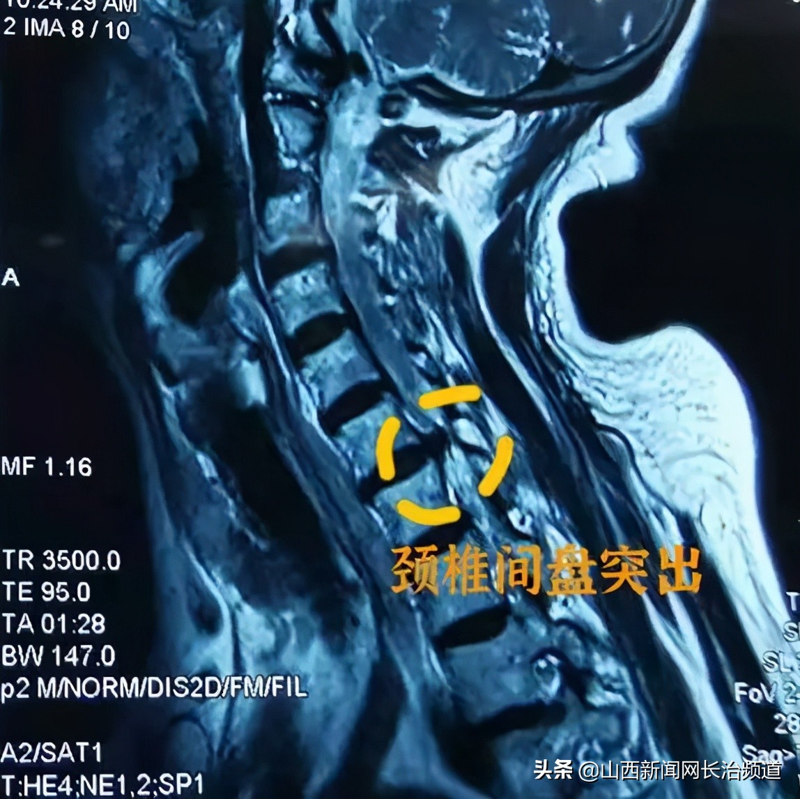 和平技术|疼起来要命的颈椎,一个“钥匙孔”搞定