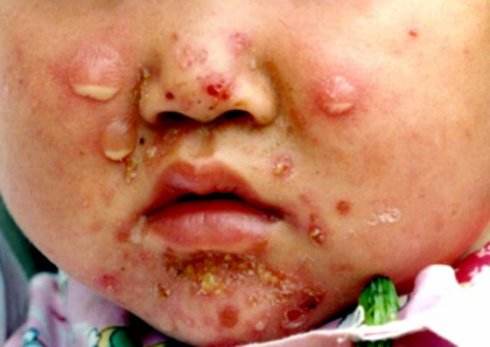 脓疱疮的症状,脓疱疮如何治疗呢其病因是什么