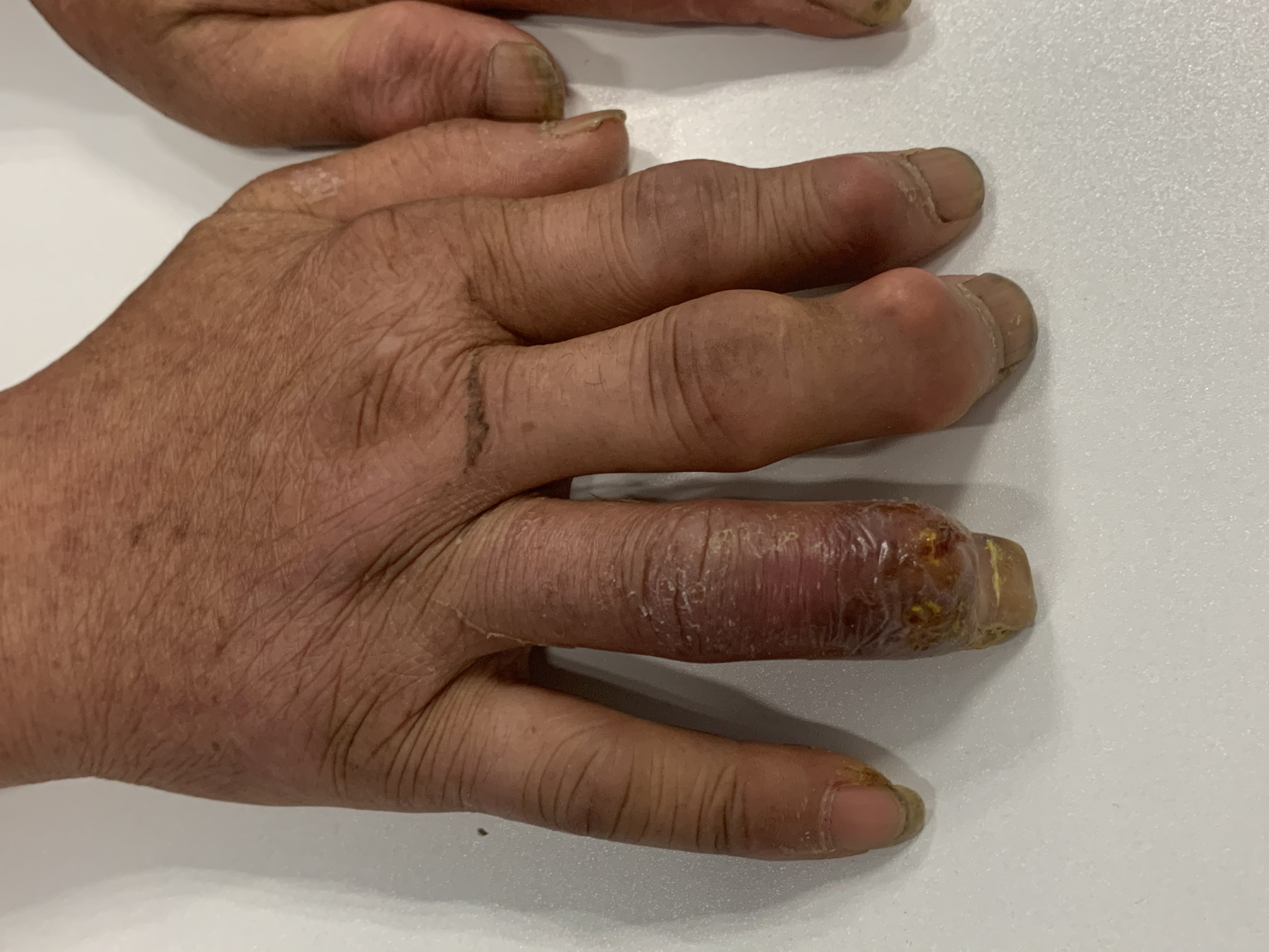 别嘌醇在痛风急性发作期能吃吗,别嘌醇痛风发作前吃吗