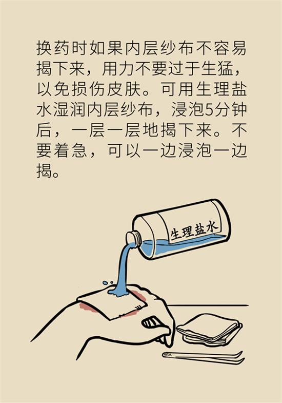 烫伤水泡如何换药,深2度烫伤换药总是有大水泡