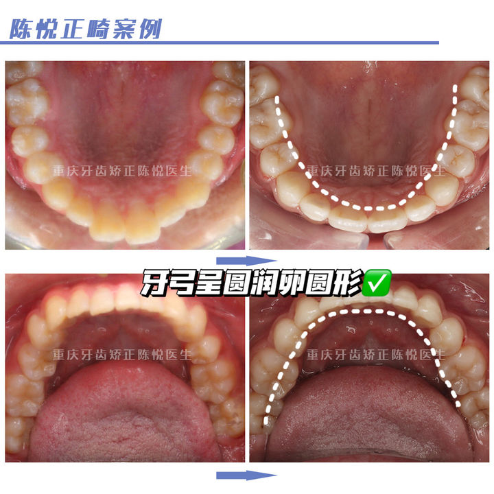 嘴凸深覆合可以自己矫正吗,上海牙齿龅牙矫正